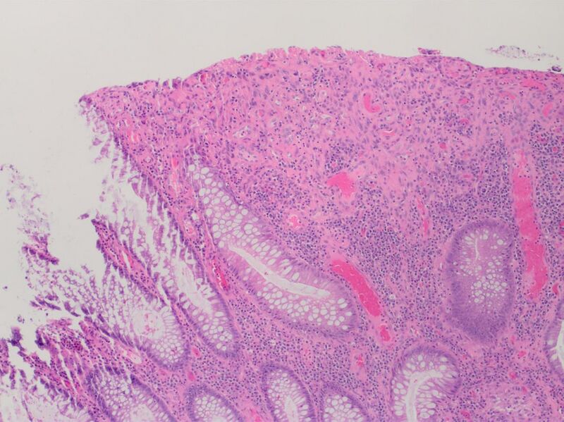 File:Histopathology of colonic ulceration.jpg