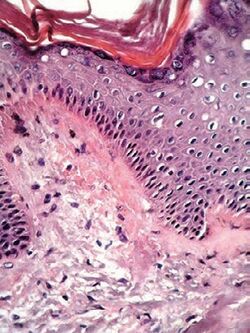 Histopathology of lichen amyloidosis with Congo red.jpg