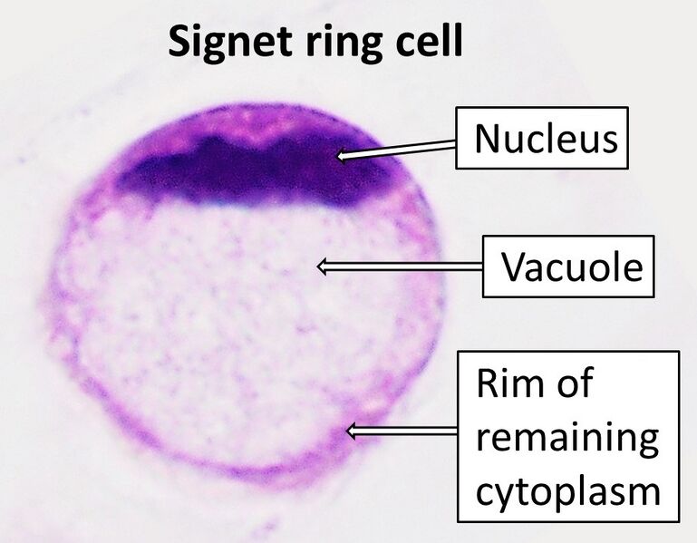 File:Signet ring cell.jpg
