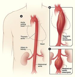 Aortic aneurysm.jpg