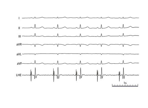 Filtered bipolar left heart electrogram in position near the coronary sinus.