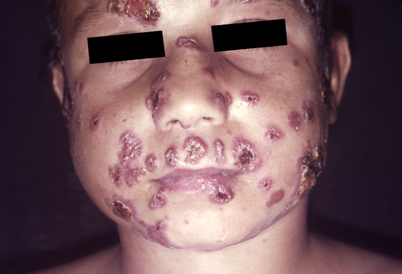 File:Paracoccidioidomycosis lesions.png