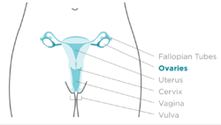 Site of ovarian cancer.png
