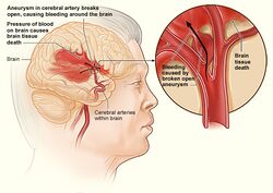 Stroke hemorrhagic.jpg