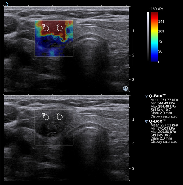 File:Thyroid SSI Szczepanek-Parulska et al. 2013 papillary thyroid carcinoma elastography.png