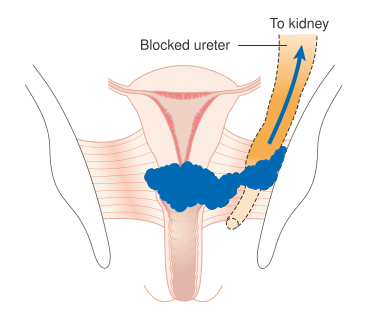 File:Diagram showing stage 3B cervical cancer CRUK 226.svg