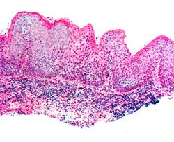 Vulvar intraepithelial neoplasia3 2.jpg