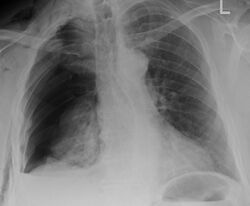 X-ray of rib fractures and pneumothorax.jpg