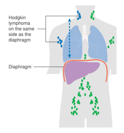 Diagram showing stage 2 Hodgkin's lymphoma CRUK 208.svg