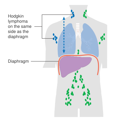 File:Diagram showing stage 2 Hodgkin's lymphoma CRUK 208.svg