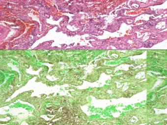 Lung biopsy showing infiltration of lymphatic tissue.png