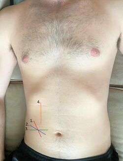 Appendectomy incision locations.jpg