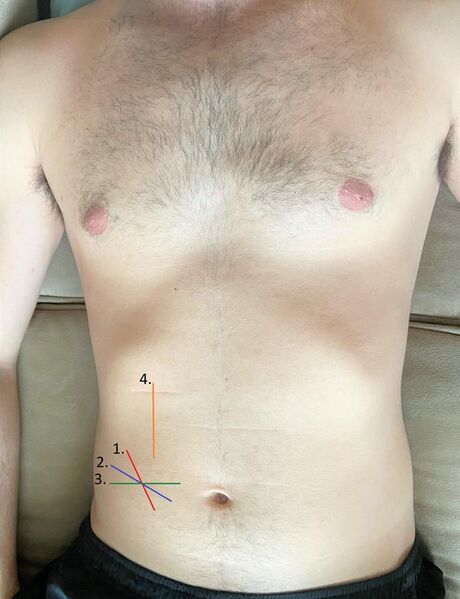 File:Appendectomy incision locations.jpg