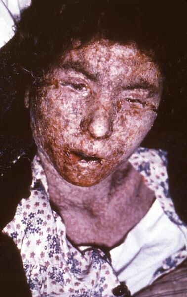 File:Female smallpox patient -- late-stage confluent maculopapular scarring.jpg
