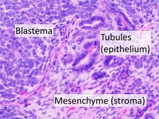 Histopathology of Wilms' tumor, annotated.jpg