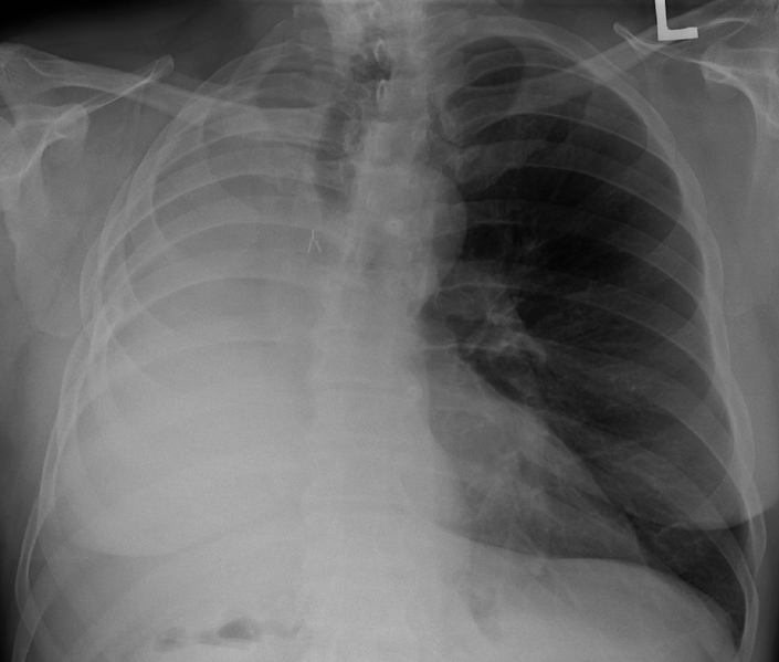 File:PneumonectomyXray.PNG