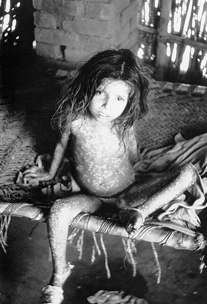 File:Smallpox child.jpg