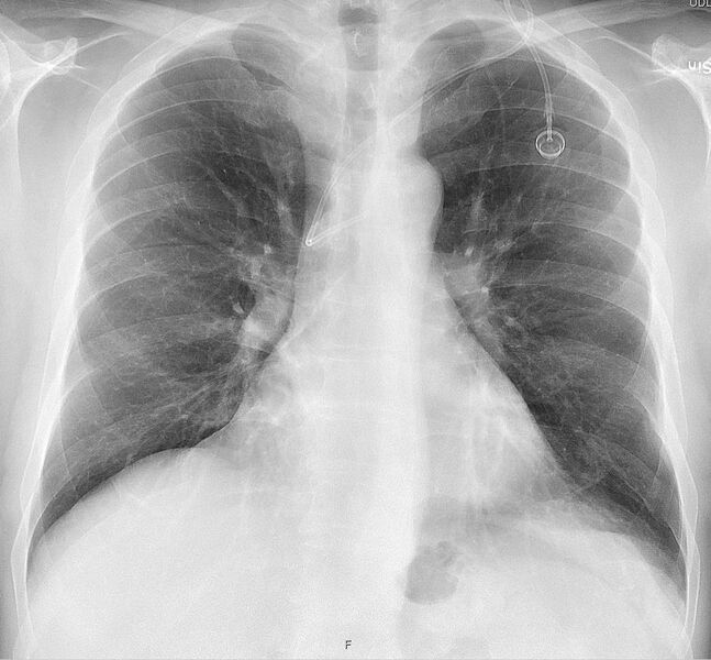 File:X-ray of port-a-cath in azygos vein - anteroposterior.jpg