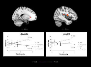 Brain imaging, comparing adolescents with CFS and healthy controls showing abnormal network activity in regions of the brain.