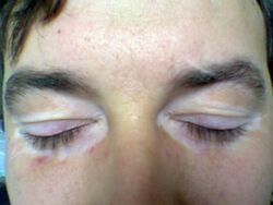 Eyelid vitiligo 06.jpg