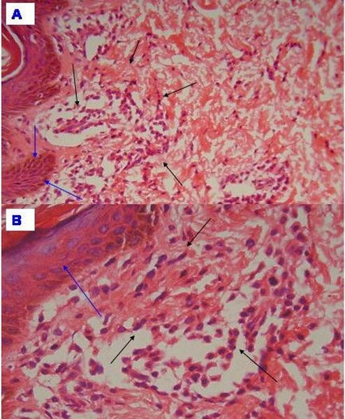 File:Histopathology of urticaria pigmentosa.jpg