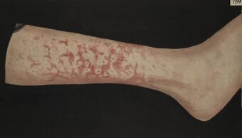 Leg with erythema marginatum Wellcome L0061869.jpg