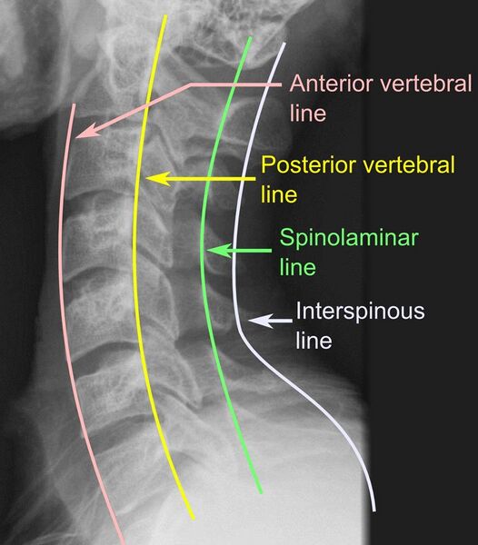 File:X-ray of vertebral lines.jpg