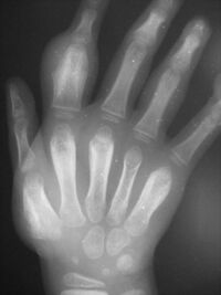 radiograph showing same hand with thickened bones