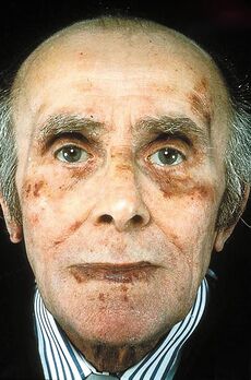 Amyloid fibril formation and classic facial features of AL amyloidosis.jpg