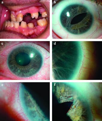 Axenfeld syndrome.jpg