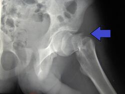 Cdm hip fracture 343.jpg