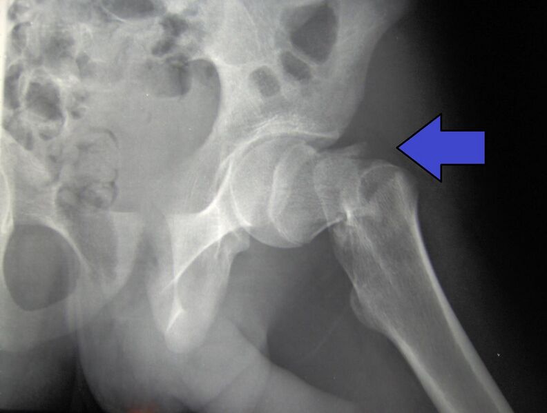 File:Cdm hip fracture 343.jpg