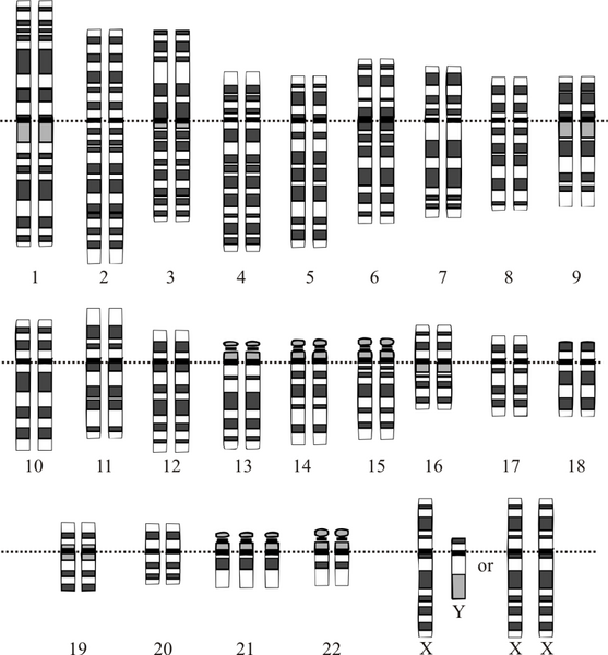 File:Down Syndrome Karyotype.png