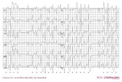 ECG000033 (CardioNetworks ECGpedia).jpg