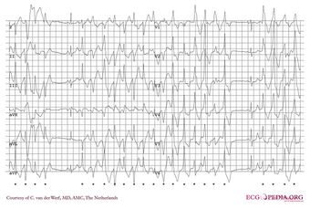 ECG000033 (CardioNetworks ECGpedia).jpg