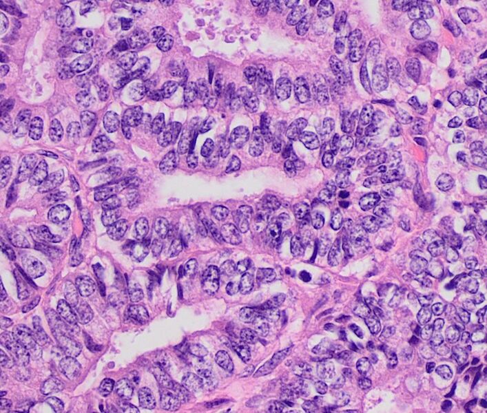 File:Histopathology of endometrioid cancer, grade 1, nuclear grade 2.jpg