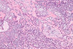 Hyalinizing clear cell carcinoma - intermed mag.jpg