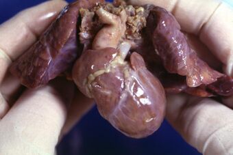 A post-mortem example of an infant heart and lungs, the heart has Hypoplastic Right Heart Syndrome