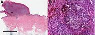 Histopathology of nodular melanoma.jpg