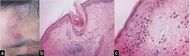 Histopathology of systemic lupus erythematosus.jpg