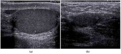Scrotal ultrasonography of undescended testis.jpg