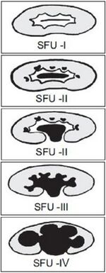 Society for Fetal Urology (SFU) grading of hydronephrosis.jpg