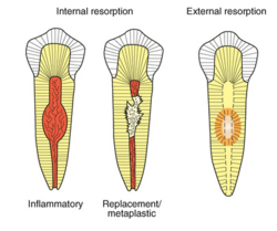 Types of Resorption.png