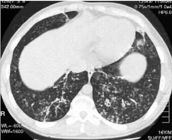 HRCT scans of diffuse panbronchiolitisCropped.jpg