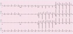 ECG Sinus Tachycardia 125 bpm.jpg