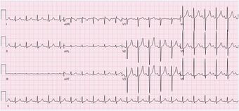 ECG Sinus Tachycardia 125 bpm.jpg