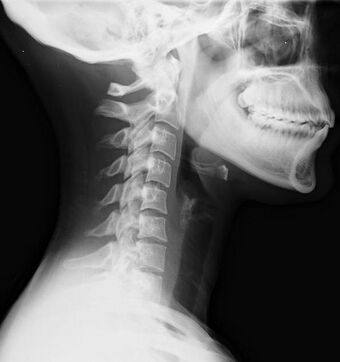 Lateral neck X-ray of whiplash.jpg
