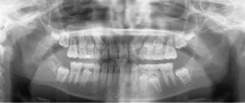 File:Mixed dentition pan.jpg