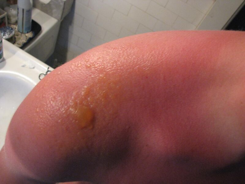 File:Sunburn blisters.jpg