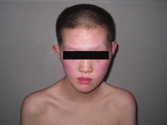 XXXXY syndrome with prognathism, widened nasal bridge, and delayed puberty.png